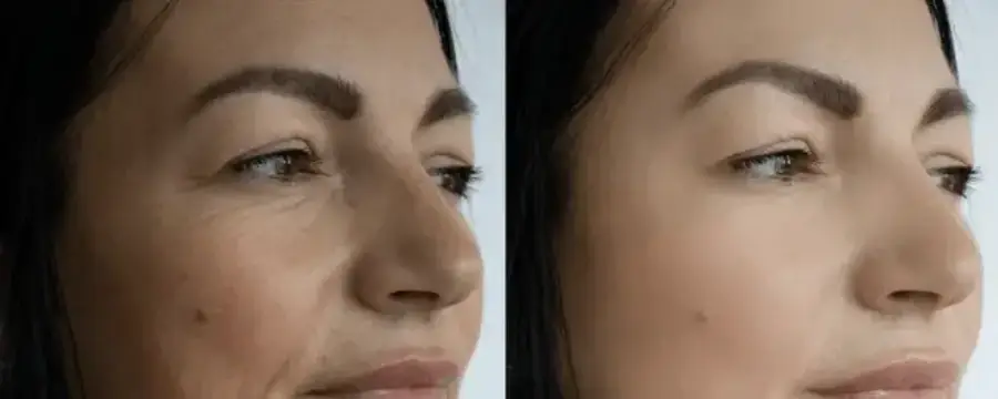 face-wrinkles-before-after-treatment-260nw-2281710475